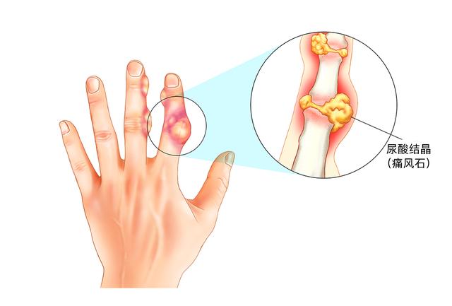 常见的痛风，在不同阶段会出现不同状态，这3种你都知道吗？