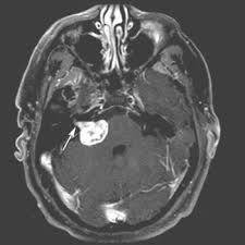 听神经瘤是一种什么样的疾病？