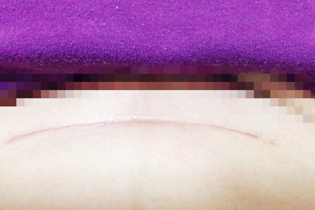 你的育儿经■产科医生说出实情：剖腹产“刀口”对女性身体有这些伤害，别大意