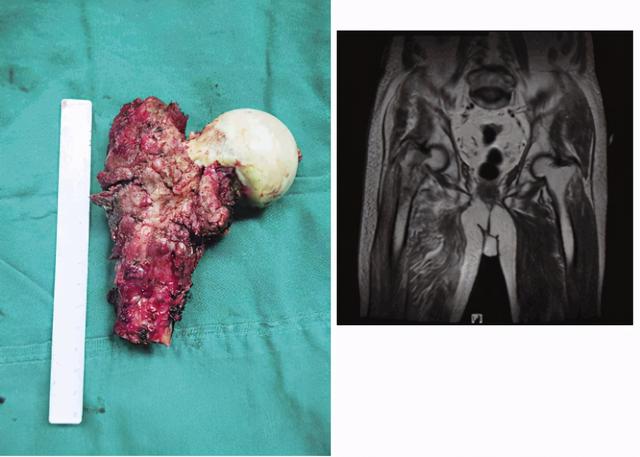 98岁老人肺癌骨转移，在南方中西医结合医院置换股骨头成功