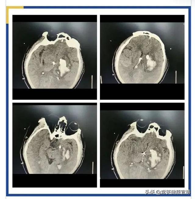 万一脑出血了，正规诊疗流程你知道吗？