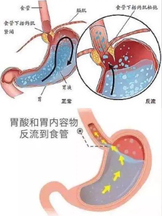 手术|科普丨手术前是否需要长时间禁食禁水？麻醉医生告诉你……