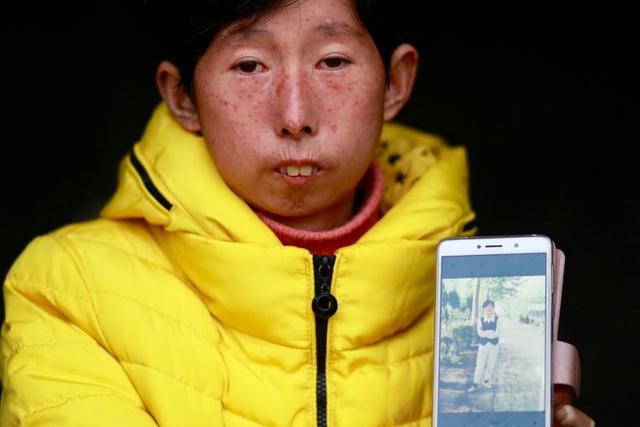 患者|无法微笑的人：有药却用不到，是最绝望的事