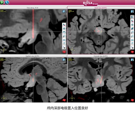 癫痫|3岁女童爱笑性格好？原来是脑内错构瘤！不开颅置入电极根除病灶治癫痫