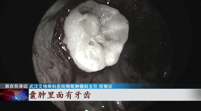 囊肿|惊呆！武汉一男子鼻腔长了牙，医生：从医40年没见过这种情况