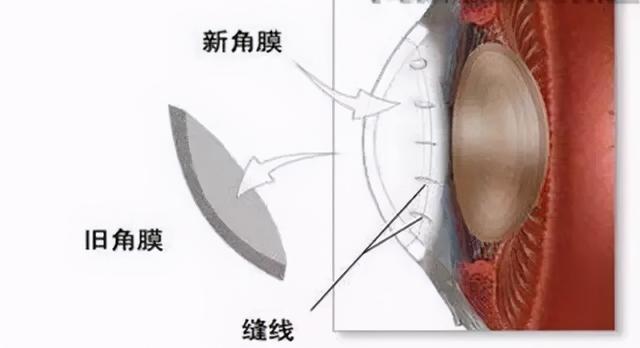 24小时内3台角膜移植手术！元旦假日，他们重见光明，最感谢的不是医生，是那个TA