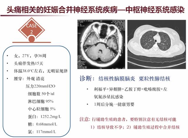 「超级宝妈」张馨：3类需要注意的妊娠合并神经系统疾病