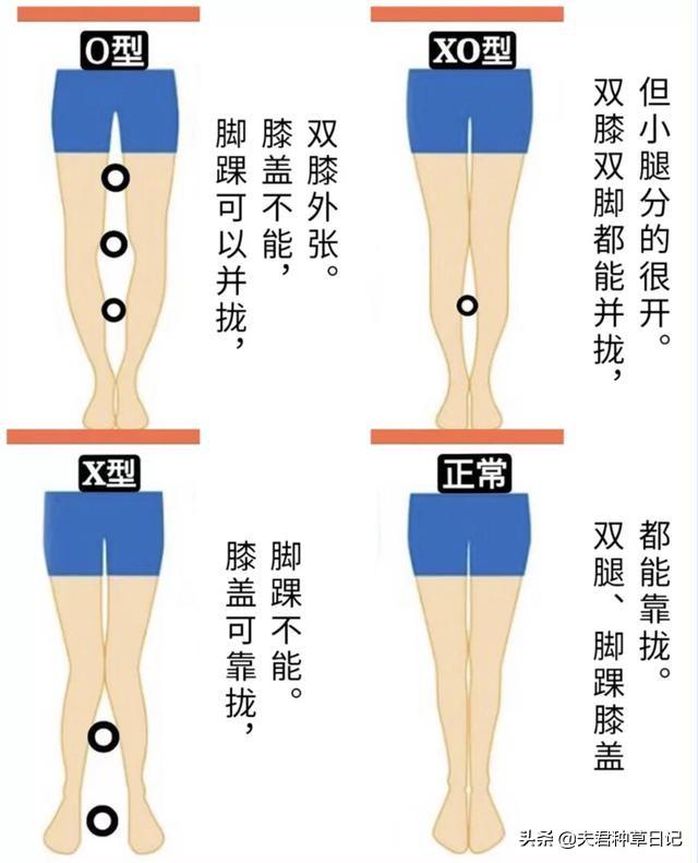 长期的不良坐姿或走路习惯引起的腿型外扩,进而引起胯部骨骼宽度增加.