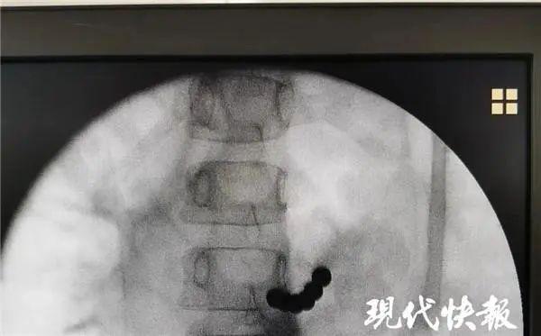 超级宝妈|痛心！两个多月15个孩子命悬一线！都是因为这种玩具