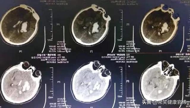 万一脑出血了，正规诊疗流程你知道吗？