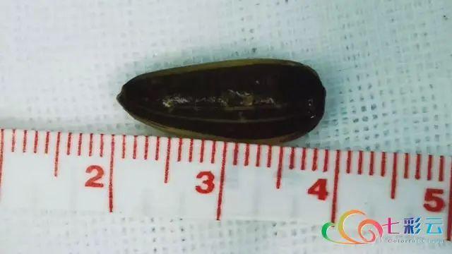 环球网|家长注意！玉溪多名儿童误食这种东西，险些夺命！B超触目惊心…