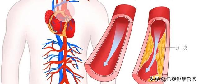 血管生锈了直接导致4种“难治病”！要怎么清理？
