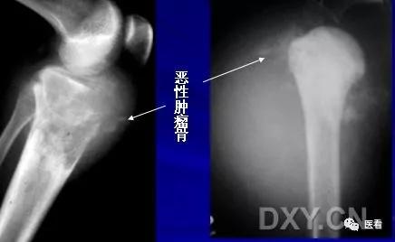 9个骨肿瘤医学影像诊断分析基本要点，如此精彩怎能错过