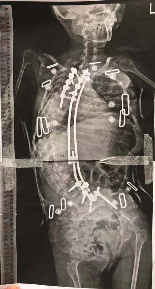 手术|13岁女孩脊柱侧弯176°:说话不成句 医生预期生命5岁