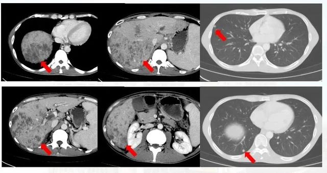 名医说肿瘤｜31岁男子患晚期肝癌肺转移，4个月后奇迹发生…