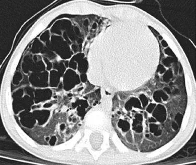 一文总结│儿童肺朗格汉斯细胞组织细胞增生症的诊断及治疗