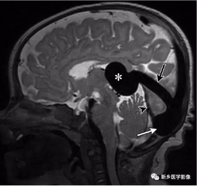 大脑中线处常见的25种疾病