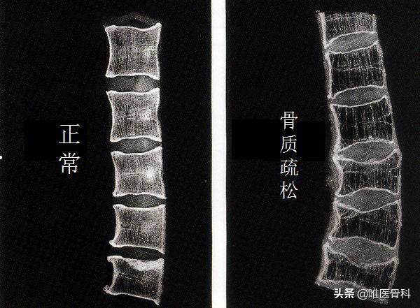 驼背|老年人为什么会驼背，而且越老越驼？