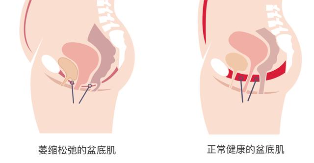 产后“漏尿”是尴尬还是可怕？别让无知影响你的一生