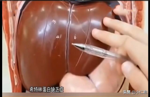 超级宝妈|6月大婴儿患罕见遗传病，严重肝衰竭命悬一线，伟大母亲割肝救子