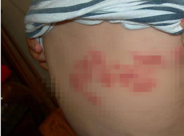 世上最痛苦的皮肤病是什么？临床排名前三的病，全经历过的是超人