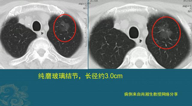 磨玻璃结节就是肺癌吗？