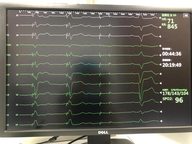 真正意义的生理性起搏——左束支区域起搏 在山西省汾阳医院心内科一病区成功开展