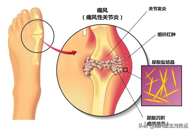 解锁降尿酸治疗后痛风发作不止的原因：伪降酸、溶晶痛和不良生活