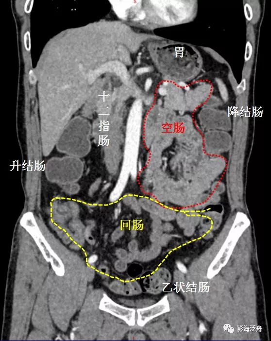 这个病，腹部CT经常会漏诊