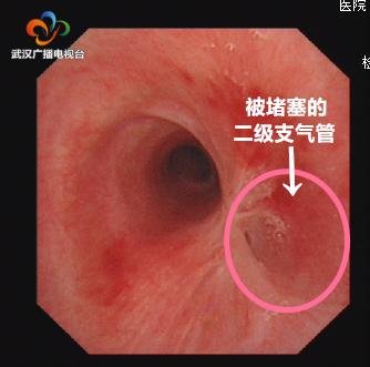 右肺泄气“病退”左肺和心脏“鸠占鹊巢”医生奇招化解脏腑“抢地盘”