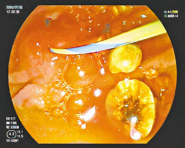 ERCP一次诊断取石，九成胆管结石“不开刀”解决