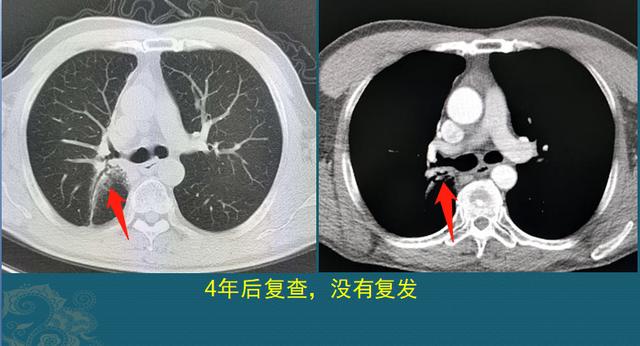 肺癌能治好吗？医生解释3个阶段的治疗数据，避免人财两空