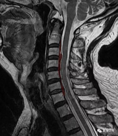 典型病例——颈椎后纵韧带钙化（MR）