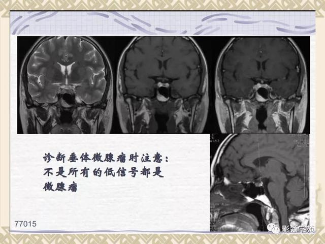 垂体病变的MRI诊断