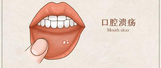 广东男子口腔溃烂，竟被查出癌症！这些坏习惯要不得，快改！