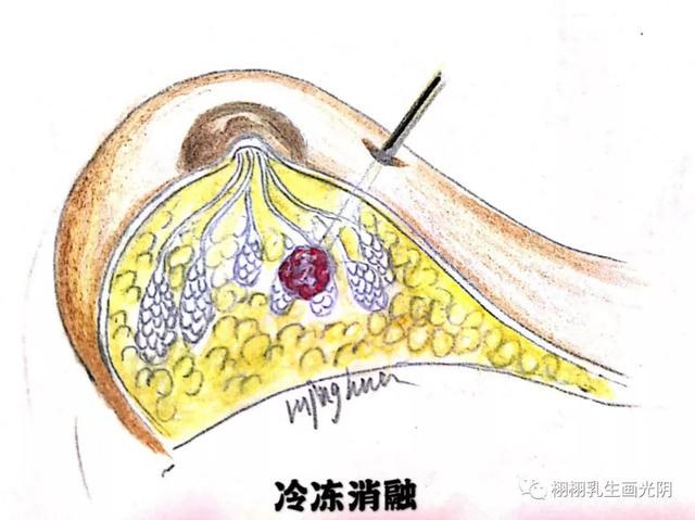 乳腺癌的照妖镜-钼靶检查