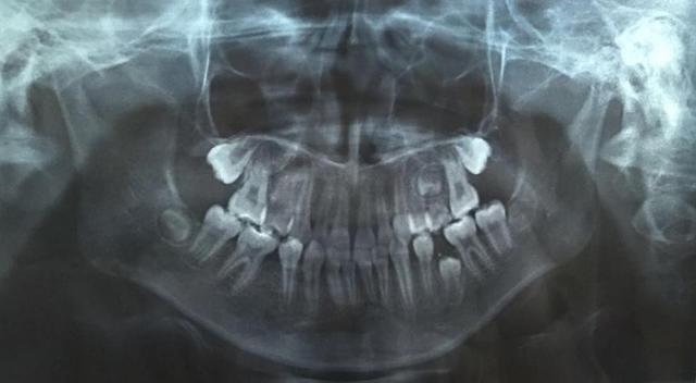 牙齿|哈尔滨这些孩子牙都咋“伤”的？宝妈快快看过来