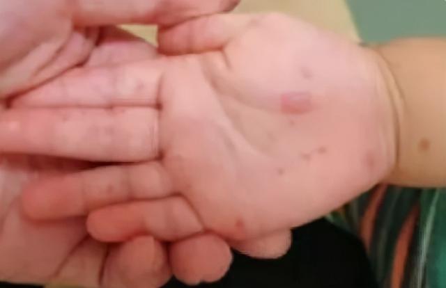 手足|让家长们担心的“手足口病”又来了！这病在广东省有季节性高峰
