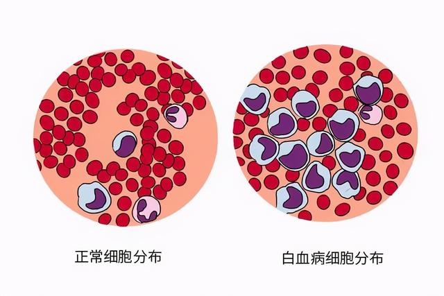 白血病患者，用化疗药物时，有啥需要注意的？医生给出诚心建议