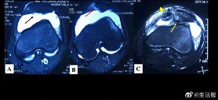 髌骨|14岁男孩打篮球“太猛”，骨折了……