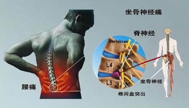 腰椎间盘突出症患者自我康复锻炼的秘方