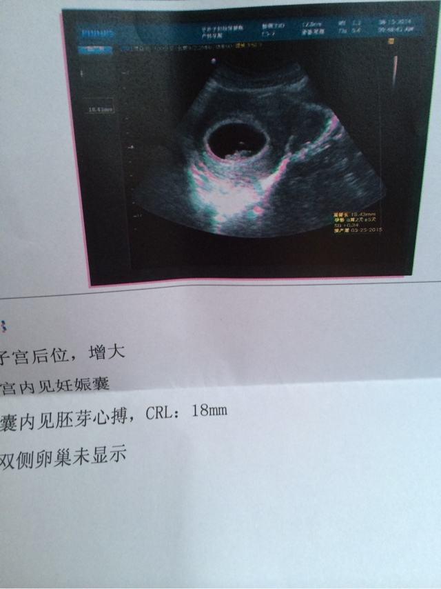 你的育儿经|8周不见胎心芽，宝宝是不是不在啦？