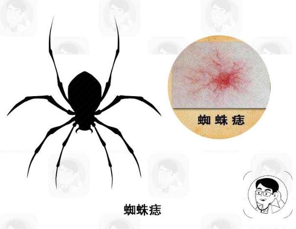 2,皮肤出现"蜘蛛痣",难道过敏了?