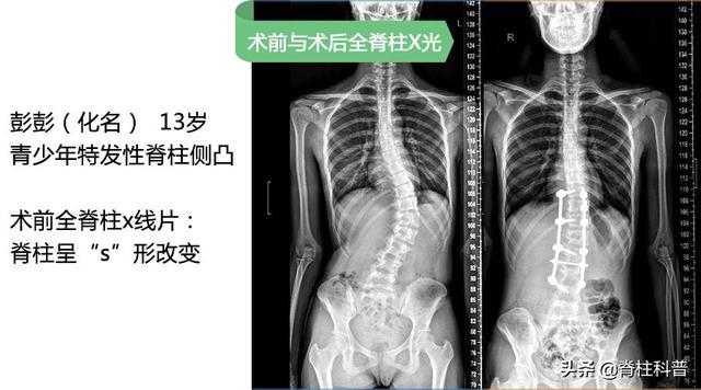 宝妈宝爸，需要GET到这项技能---如何发现孩子是否有脊柱侧凸？