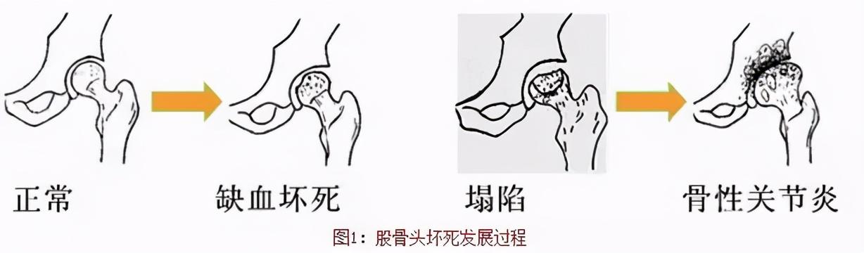 常见的八大骨关节疾病