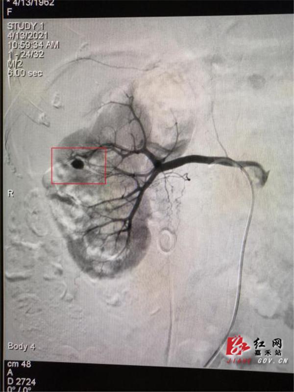 出血|嘉禾县中医医院：微创介入 妙手回春