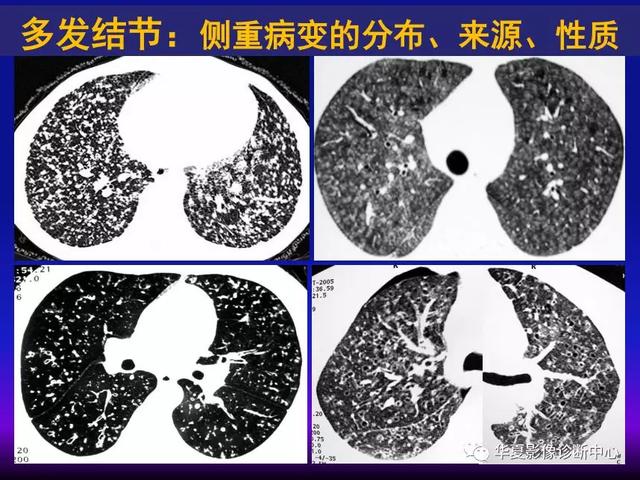 肺间质性疾病的解剖、病理、影像分析