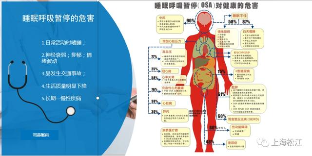 打鼾|你睡觉打呼噜吗？这种情况很危险