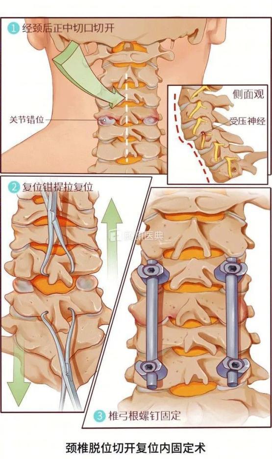 65岁老人腰疼10年整夜不能睡，这个病从15岁就要开始防