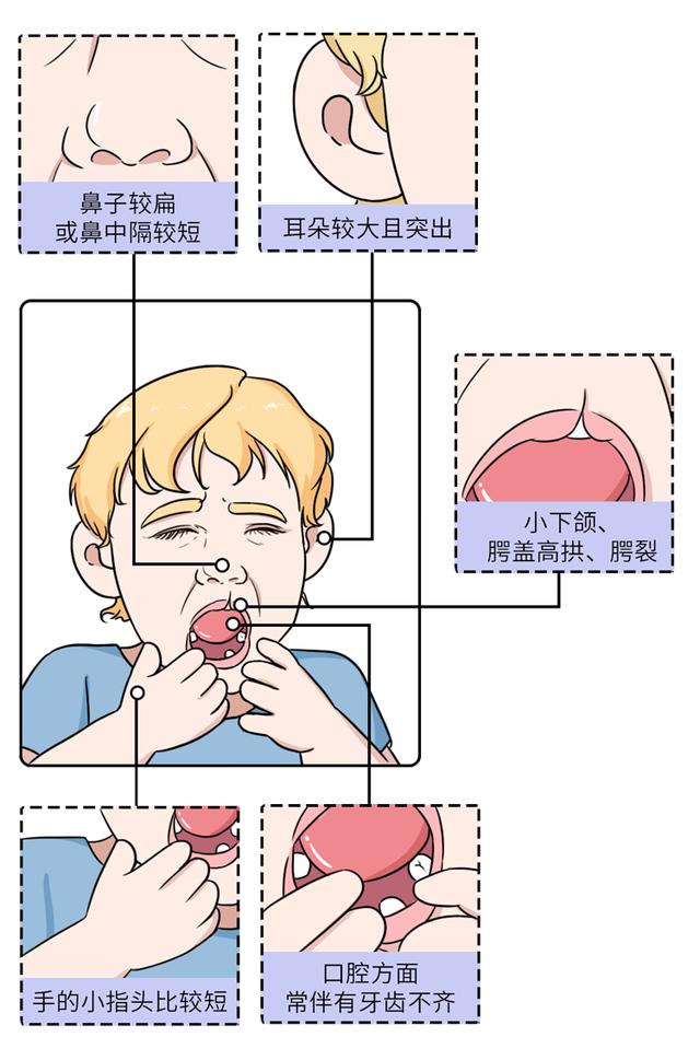 长得好看未必是件好事，可能是这种“遗传病”，不能高兴得太早